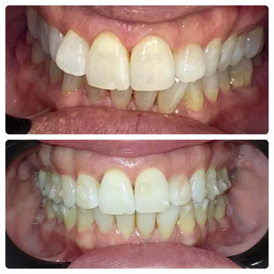 Caso de antes e depois — Odonto 4D