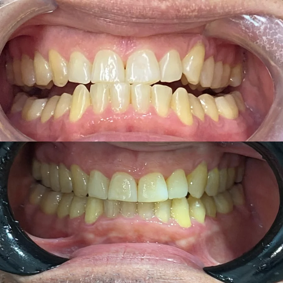 Caso de antes e depois — Odonto 4D