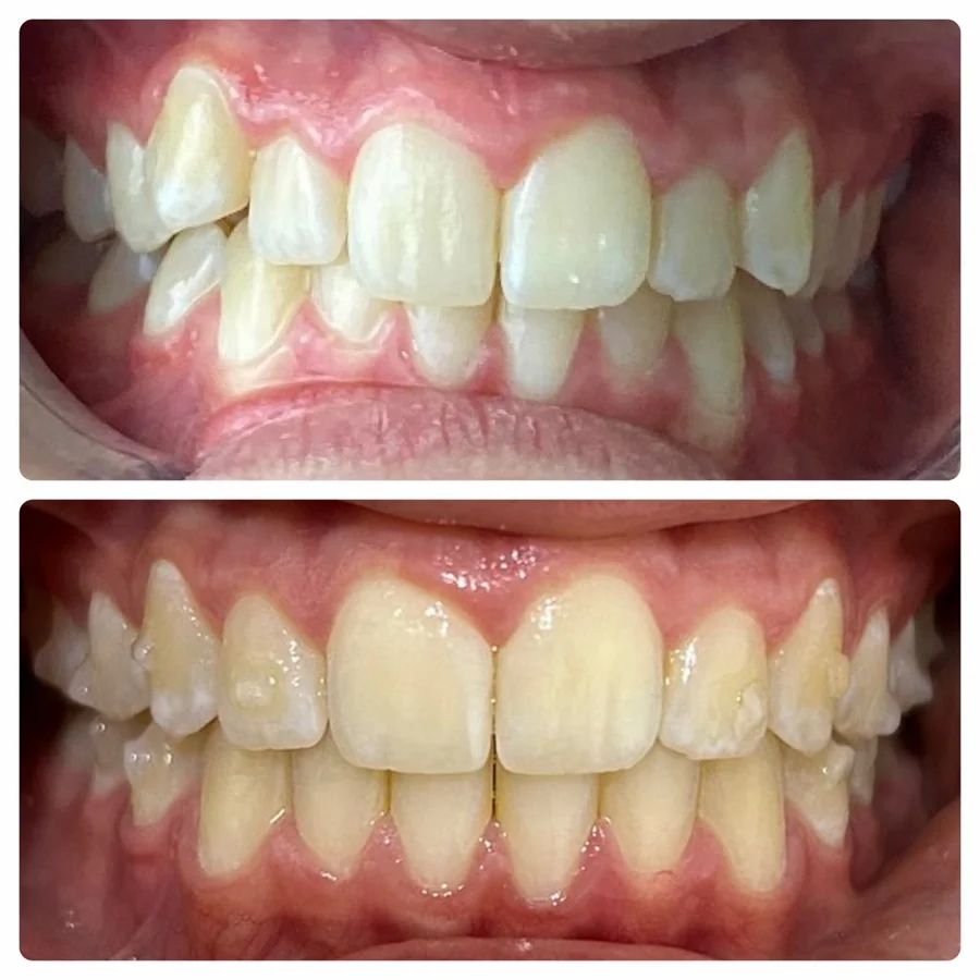 Caso de antes e depois — Odonto 4D
