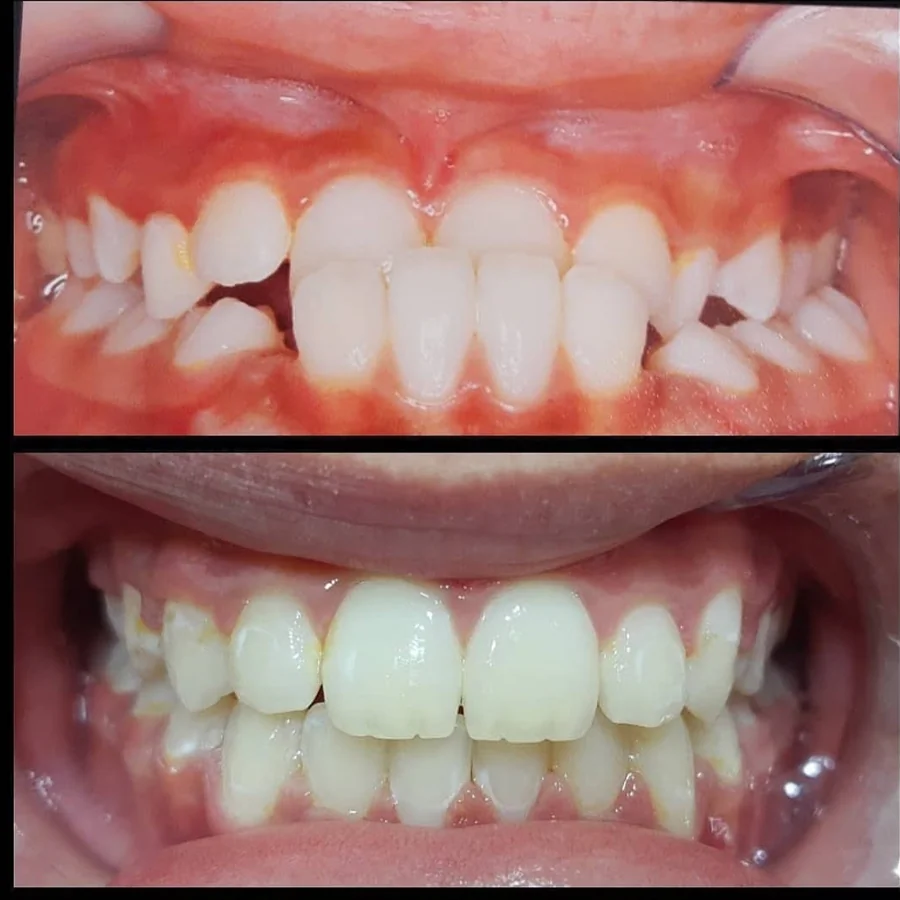 Caso de antes e depois — Odonto 4D