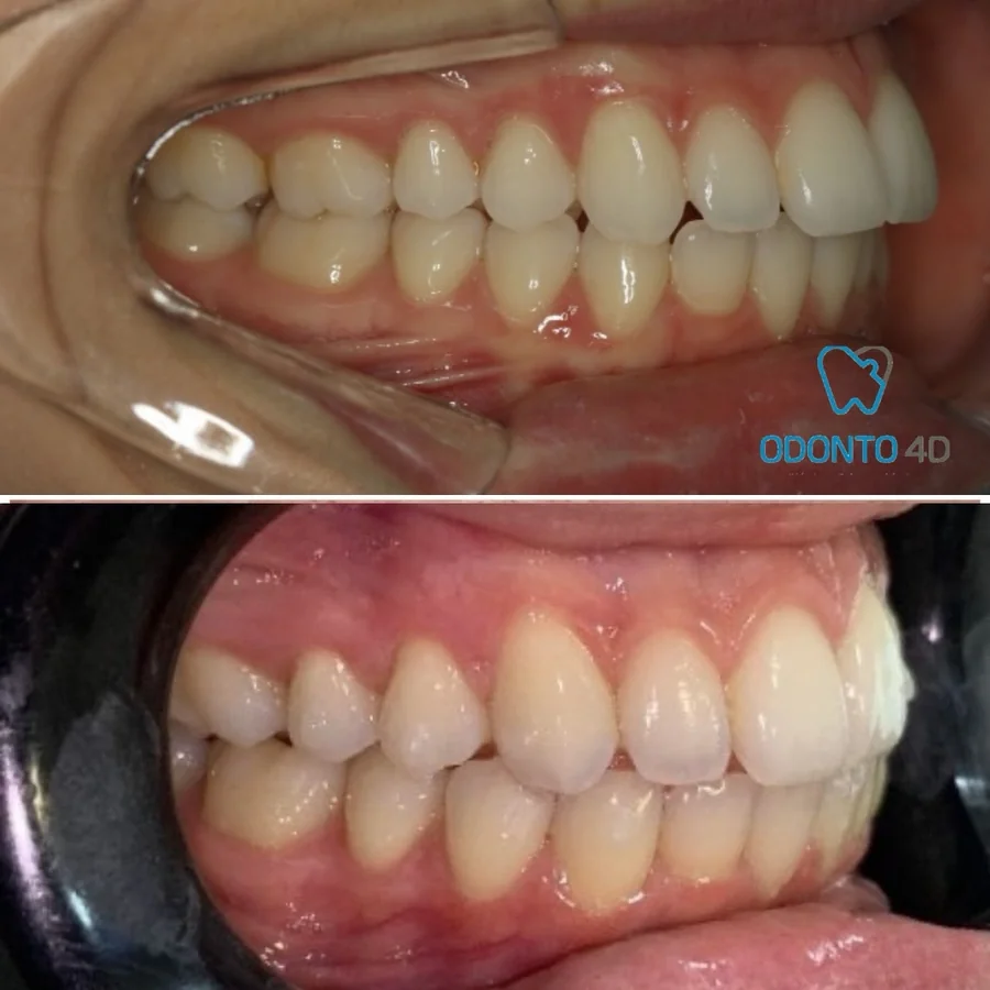 Caso de antes e depois — Odonto 4D