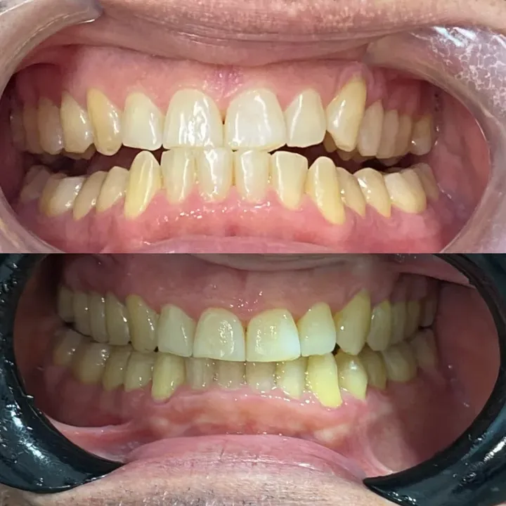 Caso real tratado pela Dra. Bruna: dentes no início e no final do tratamento