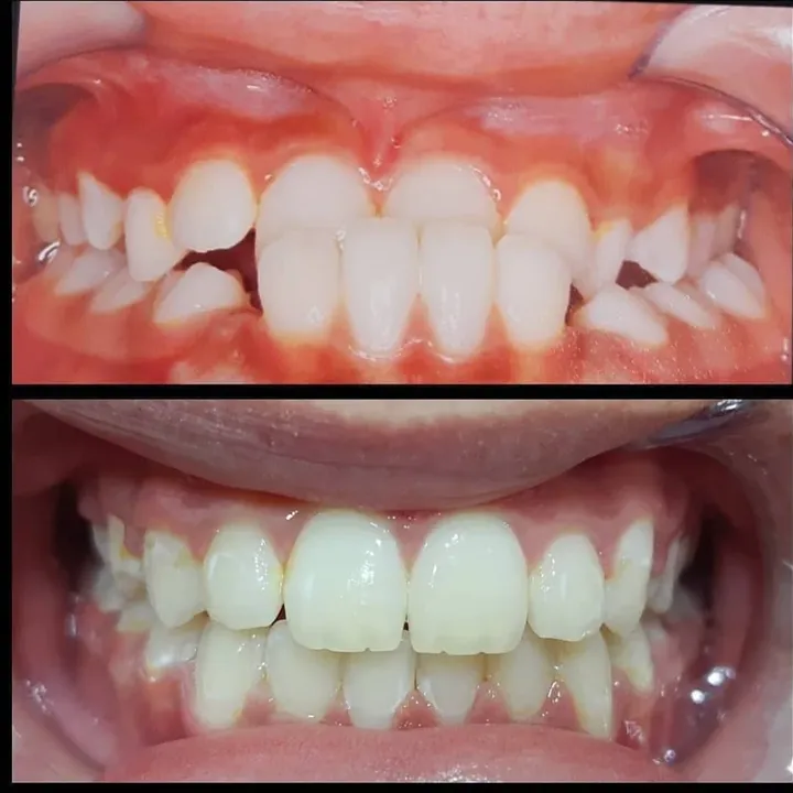 Caso real tratado pela Dra. Bruna: dentes no início e no final do tratamento